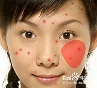 青春期長(zhǎng)痘痘了怎么消除，全面解析與應(yīng)對(duì)方法，青春期痘痘消除全面解析與應(yīng)對(duì)方法指南