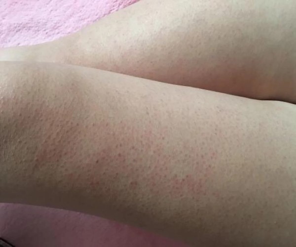 去除雞皮膚的小妙招，讓你的肌膚煥發(fā)自然光彩，雞皮膚改善秘訣，輕松告別不光滑，肌膚煥發(fā)自然光彩小妙招