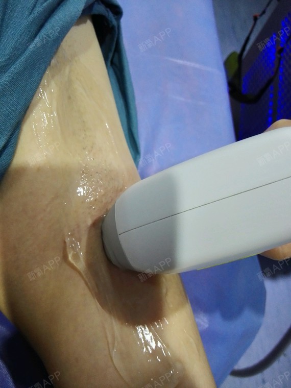 激光脫毛，疼痛感受與體驗解析，激光脫毛，疼痛感受與體驗詳解