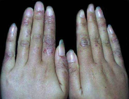 根治凍瘡，預(yù)防復(fù)發(fā)，全面解析凍瘡的治療方法，根治凍瘡，預(yù)防復(fù)發(fā)，全面解析凍瘡治療策略