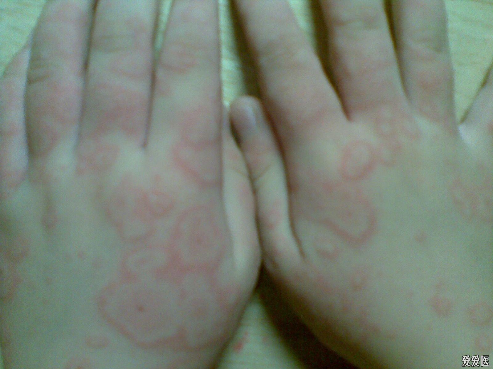 關于螨蟲過敏圖片與澳彩資料的查詢，來自94848.cσm的詳盡資源，螨蟲過敏圖片與澳彩資料查詢，詳盡資源來自94848.cσm