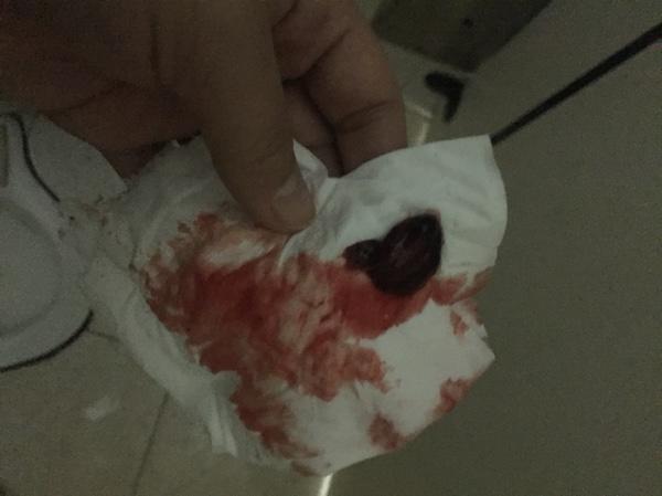 自然流產(chǎn)后的清宮問(wèn)題解析——自己流掉了需要清宮嗎？，自然流產(chǎn)后需清宮嗎？——深度解析清宮問(wèn)題疑慮！