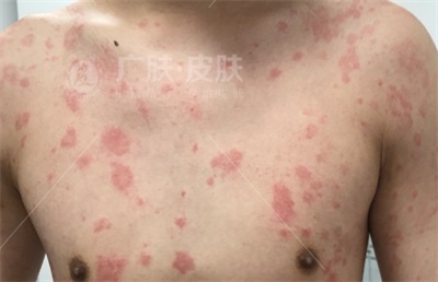 晚上發(fā)作的蕁麻疹名稱(chēng)及其相關(guān)知識(shí)解析，夜間蕁麻疹發(fā)作解析，癥狀、原因與知識(shí)科普