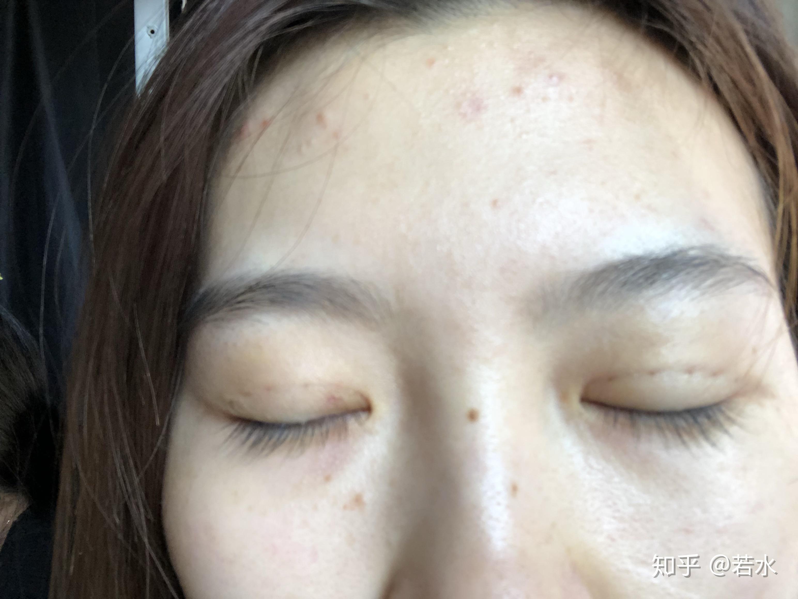 雙眼皮埋線手術(shù)效果持久性解析，持續(xù)時(shí)間與影響因素探討，雙眼皮埋線手術(shù)的持久性與影響因素深度解析