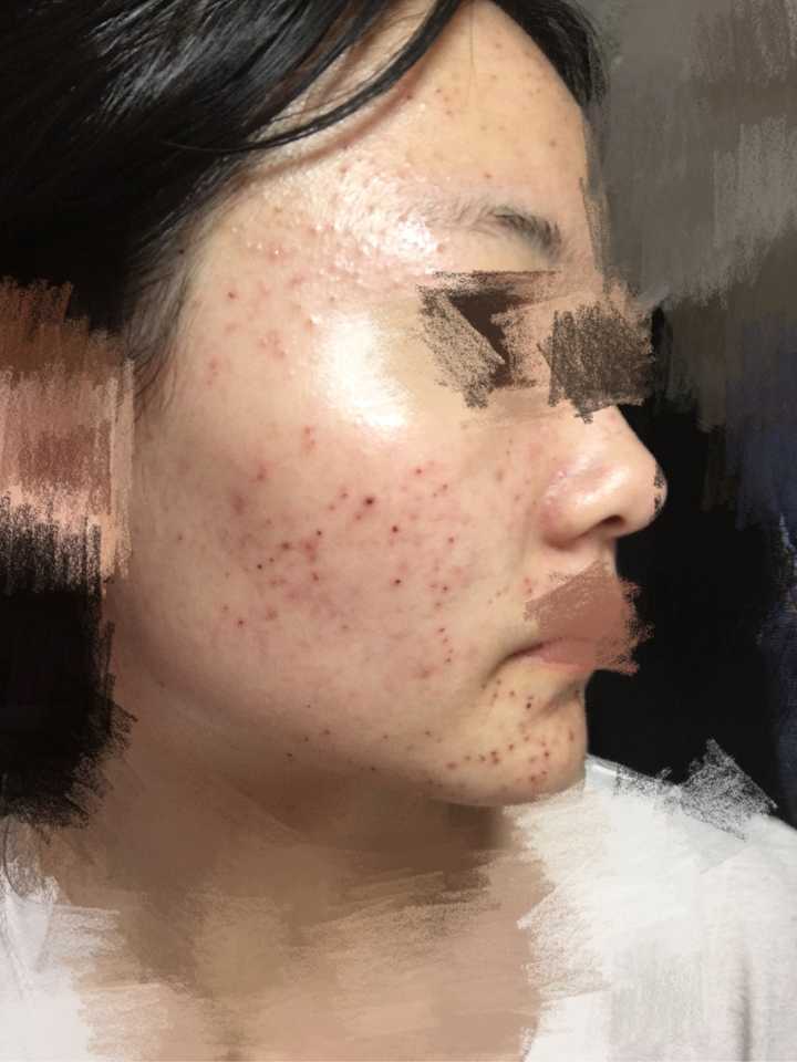 激光祛痘痘有效果嗎，深度解析與全面理解，激光祛痘效果深度解析與全面理解指南