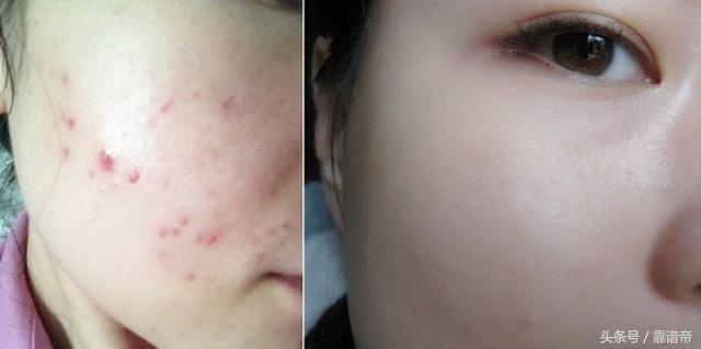 如何祛痘最快最有效的方法，全面解析痘痘成因與解決方案，揭秘最快最有效的祛痘方法，全面解析痘痘成因與解決方案！