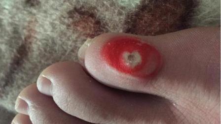 10分鐘治雞眼土方法——簡單有效的自然療法，簡單自然療法，10分鐘土方法治愈雞眼