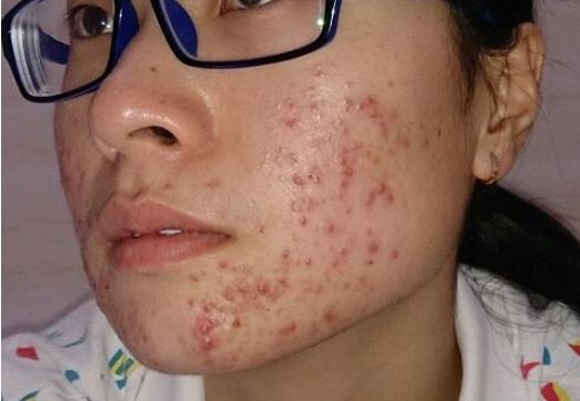 如何去除青春痘，男生的護膚指南，男生護膚指南，如何有效去除青春痘