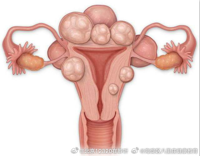 子宮肌瘤的最佳治療方法，全面解析與指導(dǎo)，子宮肌瘤的最佳治療方法詳解與指導(dǎo)手冊