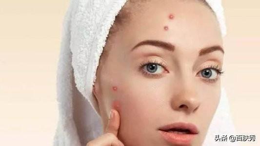 痤瘡是什么——深入了解痤瘡的成因、癥狀與治療方法，痤瘡解析，成因、癥狀及治療方法全面介紹