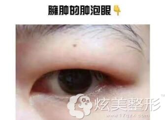 腫眼泡抽脂手術(shù)費(fèi)用詳解，多少錢？，腫眼泡抽脂手術(shù)費(fèi)用解析，手術(shù)費(fèi)用究竟是多少？